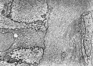 F,2d. | undefined hereditary syndrome, multiplied anomalies, sibling Acornea - keratopathy … missing Bowman membrane, disorganized stromal architecture F,2d. | undefined hereditary syndrome, multiplied anomalies, sibling Acornea - keratopathy … missing Bowman membrane, disorganized stromal architecture